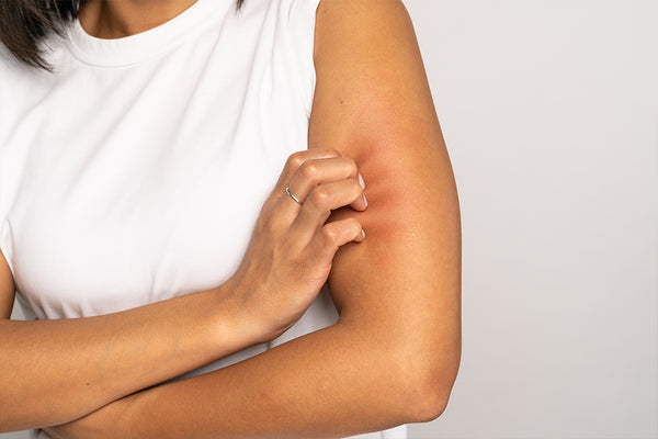 BESCHADIGDE OF GEÏRRITEERDE HUID?